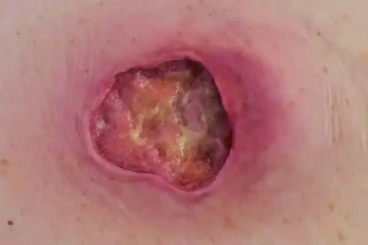 bedsore-wound-image