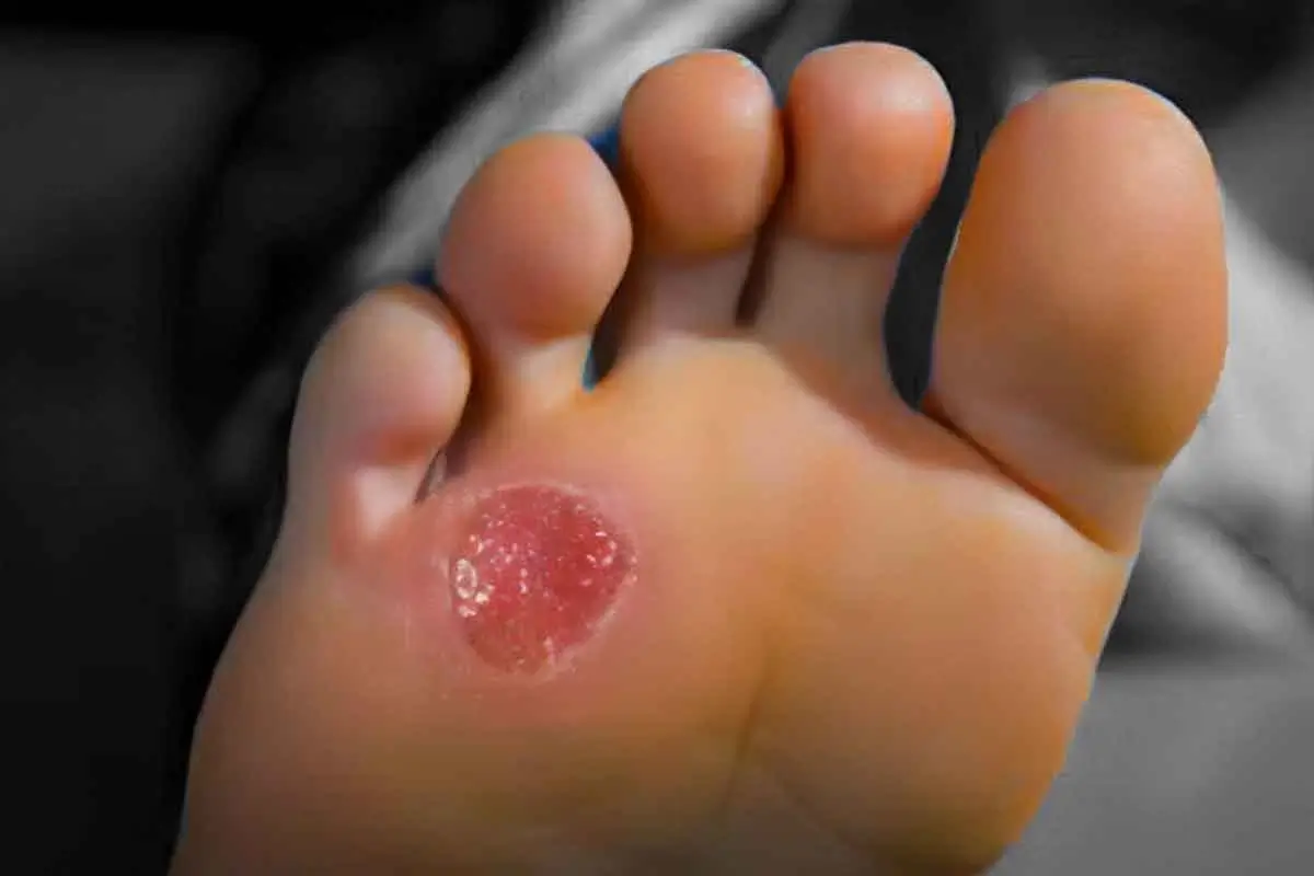 diabatic-wound-image